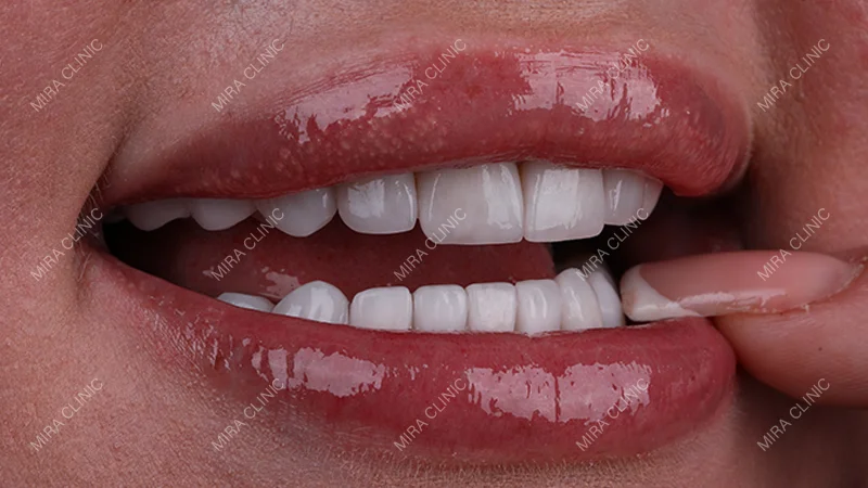 From Incorrect Bite to a 20-Tooth Smile Makeover